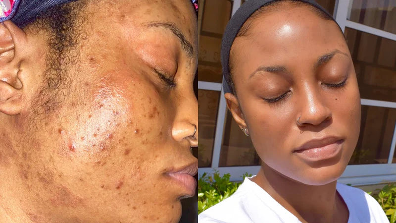 Oily & Acne-Prone Skin Combo – Control Oil, Clear Breakouts, and Soothe Skin