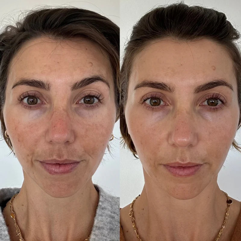 Melasma & Pigmentation Fix Combo – Fade Dark Spots, Brighten Skin!