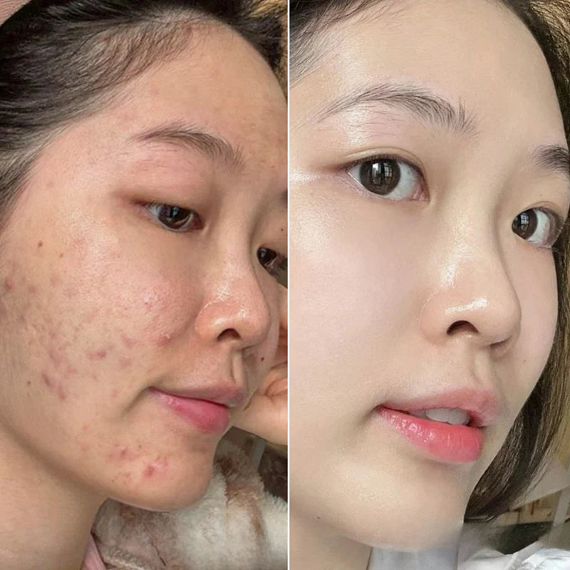 Oily & Acne-Prone Skin Combo – Control Oil, Clear Breakouts, and Soothe Skin