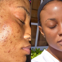 Oily & Acne-Prone Skin Combo – Control Oil, Clear Breakouts, and Soothe Skin