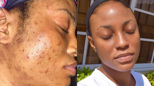 Oily & Acne-Prone Skin Combo – Control Oil, Clear Breakouts, and Soothe Skin