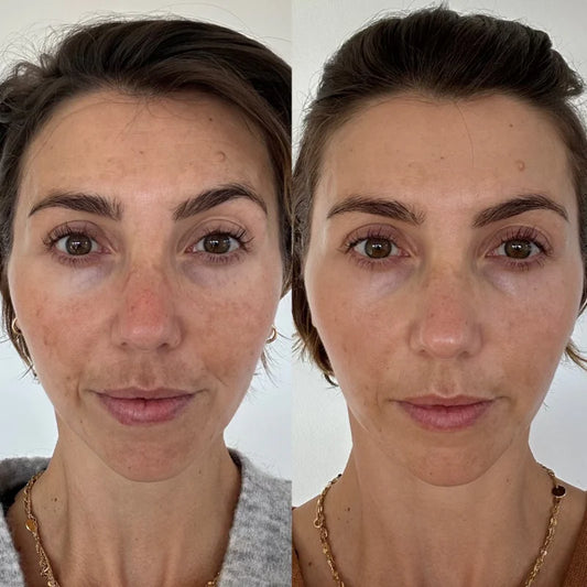 Melasma & Pigmentation Fix Combo – Fade Dark Spots, Brighten Skin!