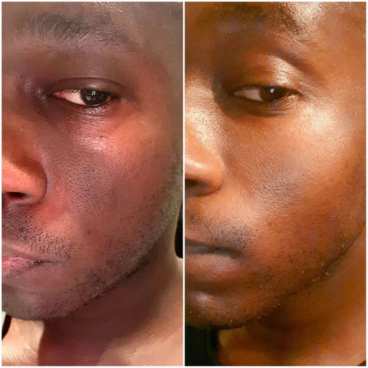Melasma & Pigmentation Fix Combo – Fade Dark Spots, Brighten Skin!