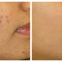 Oily & Acne-Prone Skin Combo – Control Oil, Clear Breakouts, and Soothe Skin