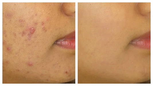 Oily & Acne-Prone Skin Combo – Control Oil, Clear Breakouts, and Soothe Skin