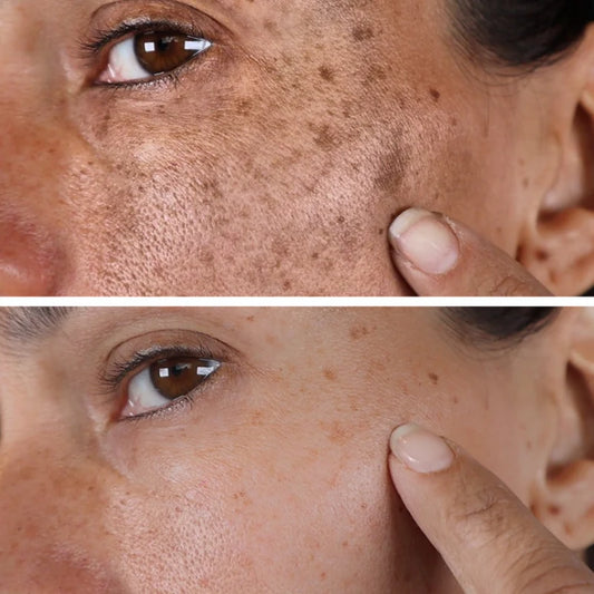 Melasma & Pigmentation Fix Combo – Fade Dark Spots, Brighten Skin!