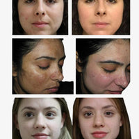 Melasma & Pigmentation Fix Combo – Fade Dark Spots, Brighten Skin!
