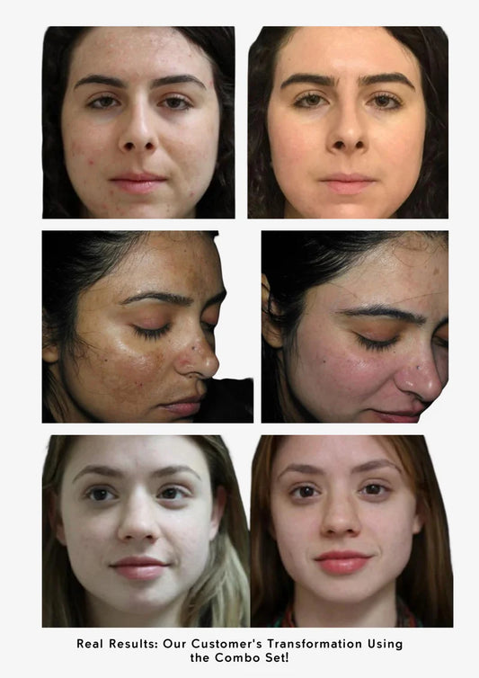Melasma & Pigmentation Fix Combo – Fade Dark Spots, Brighten Skin!