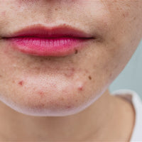 The Ultimate Skin Fix Set by The Ordinary – Banish Acne, Scars, and Dark Circles