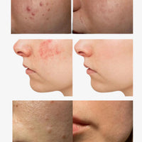 Oily & Acne-Prone Skin Combo – Control Oil, Clear Breakouts, and Soothe Skin