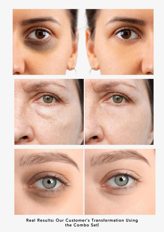 Eye Rescue Combo – Banish Dark Circles, Puffiness & Dullness